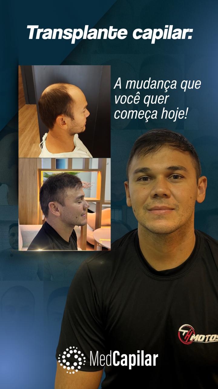 Antes e depois paciente 2