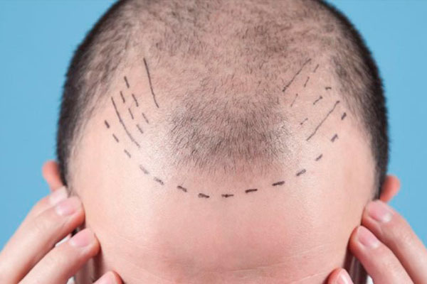 Método Hairmax na MedCapilar